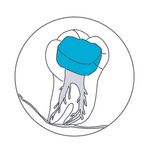 Zahngrafik provisorischer, bakteriensicherer Verschluss des Zahnes