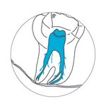 Zahngrafik Sondieren der Wurzel