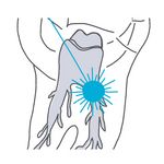 Zahngrafik Desinfektion mit dem Laser