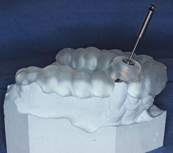 Computergeplante Bohrschablone zur endodontischen Behandlung