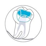 Zahngrafik Entfernung Karies und Aufbau fehlende Zahnsubstanz